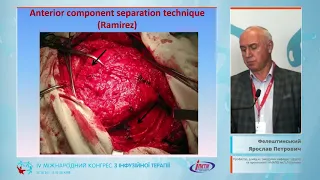 Ускладнення алопластики вентральних гриж, лікування та профілактика (Фелештинський Я.П.)