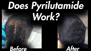 Pyrilutamide (KX-826): Before and After. Does it work?