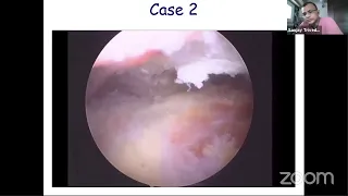 Arthroscopy Academy's- Shoulder Inability Case Discussion Dr Sameer Shaikh