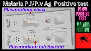 Malaria positive | Pv and Pf antigen Positive test | @medicallabtechnologysajal6903