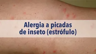 Alergia a picadas de inseto (estrófulo)