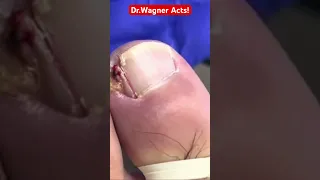 TAKE A LOOK AT THE SIZE OF THIS INGROWN TOENAIL!🤯#shorts