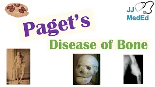 Paget’s Disease of Bone (Osteitis Deformans) | Causes, Pathogenesis, Symptoms, Diagnosis & Treatment