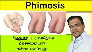 ஆணுறுப்பு முன்தோல் பிரச்சனையா?என்ன செய்வது?phimosis treatment