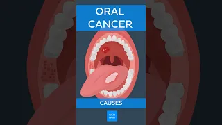 Oral cancer: Causes | Kenhub #oralcancer