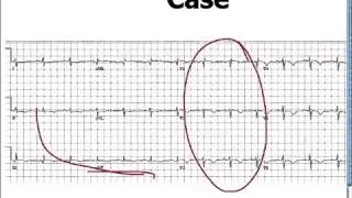 Amal Mattu's ECG Case of the Week  Sept 15, 2014   YouTube