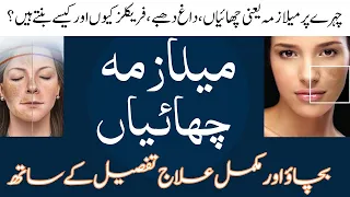 Best Treatment for Melasma in Urdu/Hindi | چہرے کی چھائیوں کا بہترین علاج | Melasma ka Ilaj