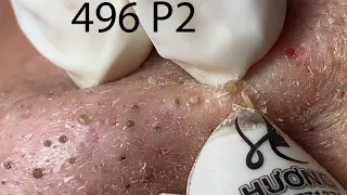 Make your Acne Treatment Huong Da Nang#496 | acne 2022 Part2