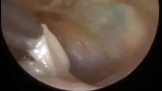 900 - Swimmer’s Ear Infection Microsuction