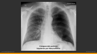 Patrones Pulmonares en la Radiografía de Tórax