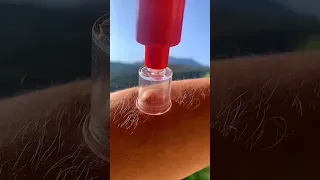 ￼Este aparato succiona el veneno de los mosquitos 🤯🦟