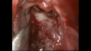 ENDOSCOPIC RECONSTRUCTION OF MEDIAL BLOW OUT FRACTURE