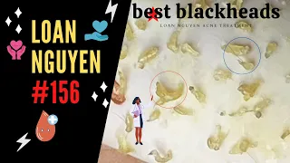 Relax with BLACKHEADS EXTRACTION and country music (156) | Loan Nguyen