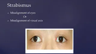 Strabismus-part 1/ Dr. Sadia Bukhari