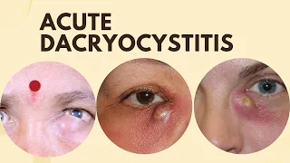 Acute Dacryocystitis.