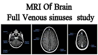 MRI Of Brain Venous sinuses  study