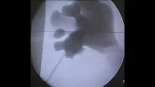 PCNL Access with Fluoroscopy    Monoplanar Two dimesion Technique Movie