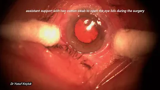 Cataract surgery in a case of Ocular Cicatricial Pemphigoid (OCP)