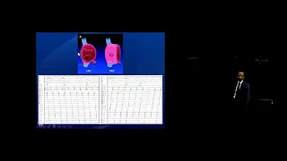 Heart Rhythm Webinar Series - Mapping Flutters