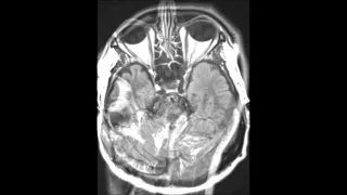 Transverse/Sigmoid Sinus Venous Thrombosis