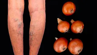 Unbelievable! Get rid of varicose veins forever! This treasure should be in every home