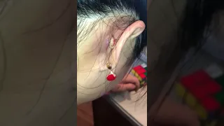 Blackheads today - Blackheads loan nguyen