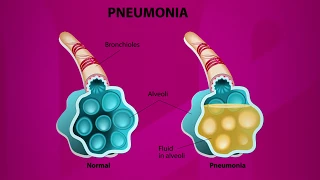 How Pneumonia Looks Like?