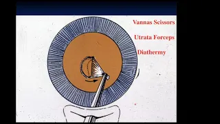 an-vision Webinar - Phacodynamics & Principles of Phacoemulisfication