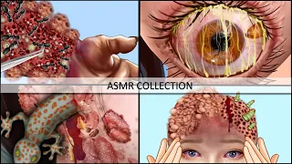 ASMR Care Animation Collection  | Infected Nose, Foot, Eye | ASMR Compilation | Universe ASMR