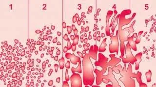 Prostate Cancer: Gleason Score