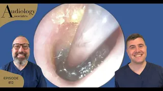 EAR WAX REMOVAL COMPILATION INC VERY DEEP IMPACTED EARWAX PLUG - EP812