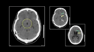 Neuroradiology Infections | Interesting Radiology Cases