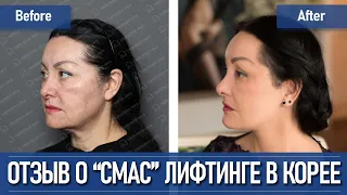 Отзыв о СМАС лифтинге в Корее