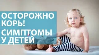 Симптомы кори! Поможет ли прививка от кори?