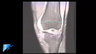 How to Read Knee MRI of Medial Meniscus Tear | Horizontal Cleavage Tear Treatment | Twin Cities, MN