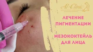 Лечение пигментации и пигментных пятен на лице. Прямой эфир с доктором Еленой Геннадьевной.