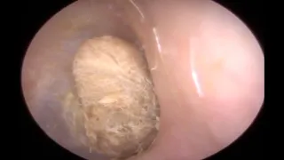 Man Gets Cotton Bud Stuck In Ear Removed