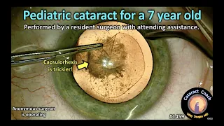 CataractCoach 1459: pediatric cataract for a 7 year old