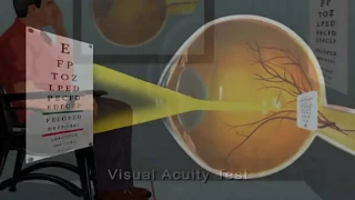 Visual acuity test - Animated Concise Dictionary of Ophthalmology