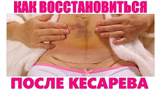 ЭТАПЫ ВОССТАНОВЛЕНИЯ ПОСЛЕ КЕСАРЕВА СЕЧЕНИЯ | Как прийти в себя после кесарева