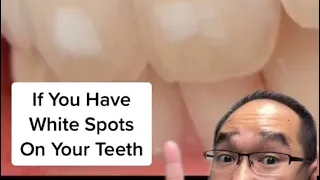 White spots on teeth? 🦷