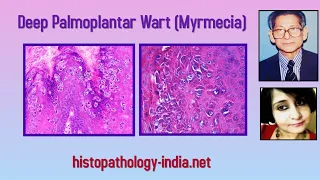 Pathology of Deep Palmoplantar Wart (Myrmecia) - Dr Sampurna Roy MD ( dermpath, dermatopathology)
