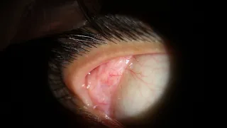 Dacryoadenitis Swollen Lacrimal Tear Gland - comes out of eye at 0:37