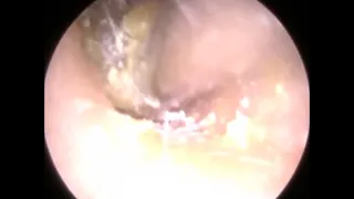 Dry Wax Removed from Ear with Eczema Otitis Externa   Mr Neel Raithatha The Hear Clinic