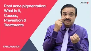Post acne pigmentation: What is it, Causes, Prevention & Treatments (English)