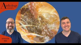 REMOVAL OF DRY EAR WAX PLUGS WITH A KERATIN UNDERLAYER - EP866