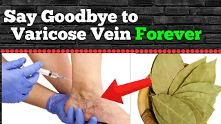 Vericose Veins Say Goodbye Forever With Bay Leaf Herb @SMARTIDEATV99