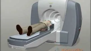 Neurology animation - Gamma Knife Surgery