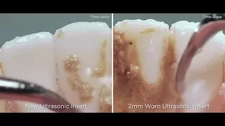 The impacts of ultrasonic insert tip wear | Dentsply Sirona