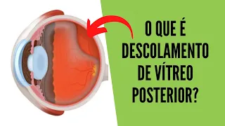 Descolamento de Vítreo Posterior - Sintomas, causas, diagnóstico e tratamentos